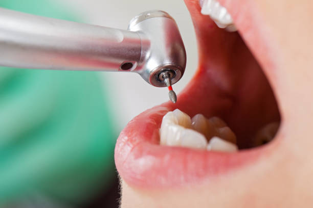 Best Emergency Dental Care for Broken or Chipped Teeth in Mountain View, AR